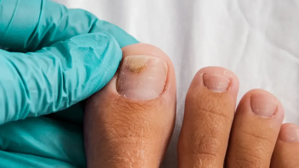 Toe Fungal Nail